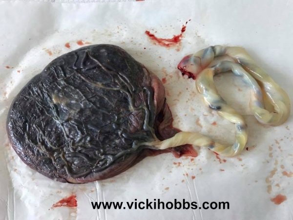 placenta encapsulation in Perth, Birth, pregnancy, VBAC, pushing baby out, Vicki Hobbs, VBAC statistics, maternity, mothers and babies, cesarean, caesarean, VBAC in Australia, Hypnobirthing Australia, VBAC in Perth, 
